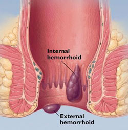 hemorroides 1